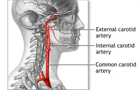 Carotid Artery Disease